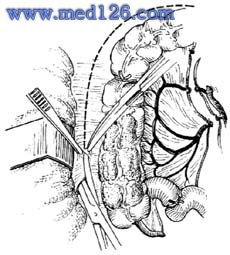 右半结肠切除手术视频,右半结肠切除手术操作步骤详解